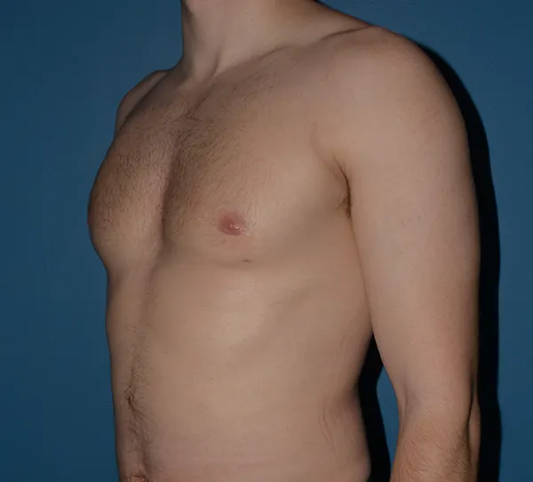 Male Breast Reduction Gynecomastia