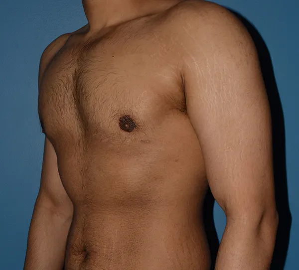 Male Breast Reduction Gynecomastia