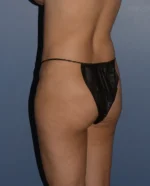 Butt Gluteal Implants