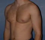 Male Breast Reduction Gynecomastia