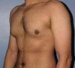 Male Breast Reduction Gynecomastia