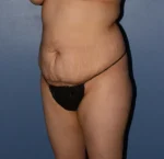 Tummy Tuck