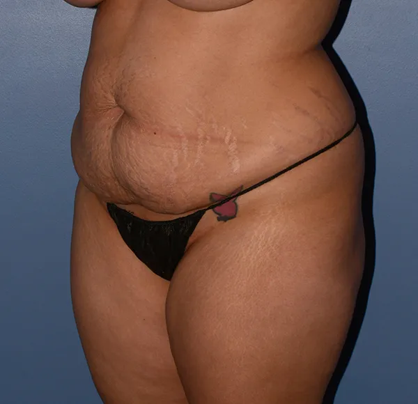 Tummy Tuck