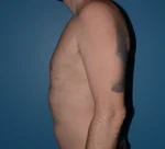 Male Breast Reduction Gynecomastia