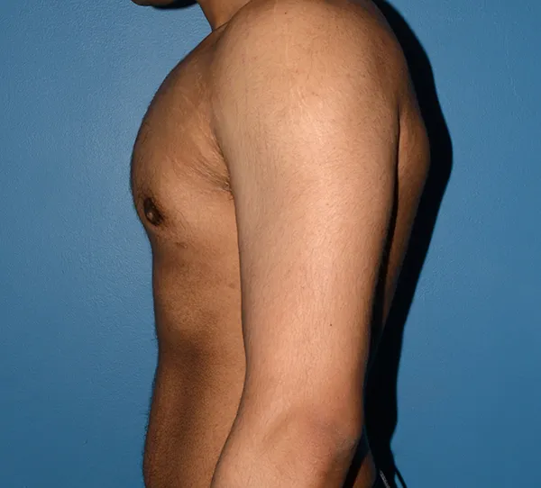 Male Breast Reduction Gynecomastia