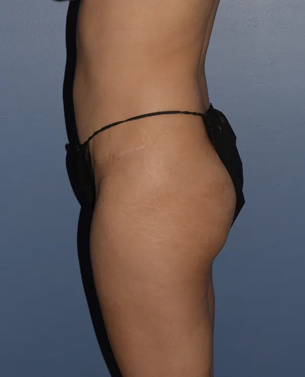 Butt Gluteal Implants