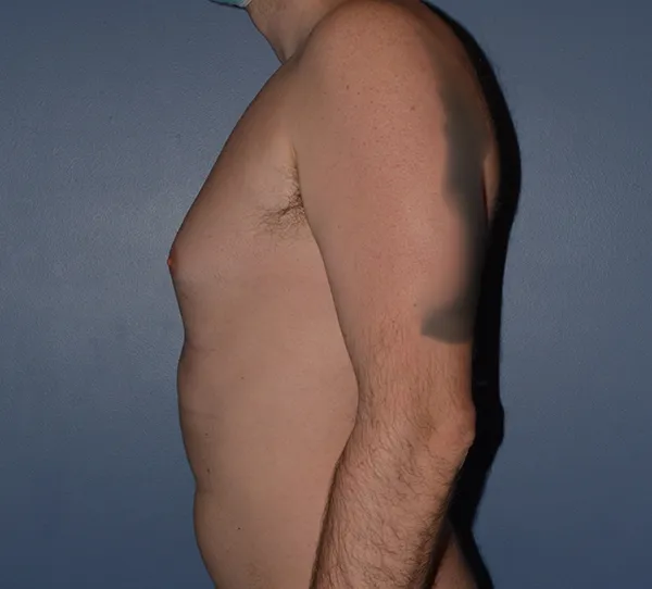 Male Breast Reduction Gynecomastia