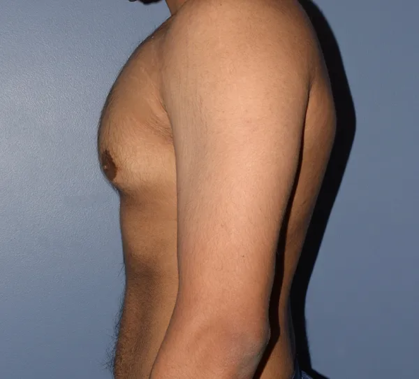 Male Breast Reduction Gynecomastia