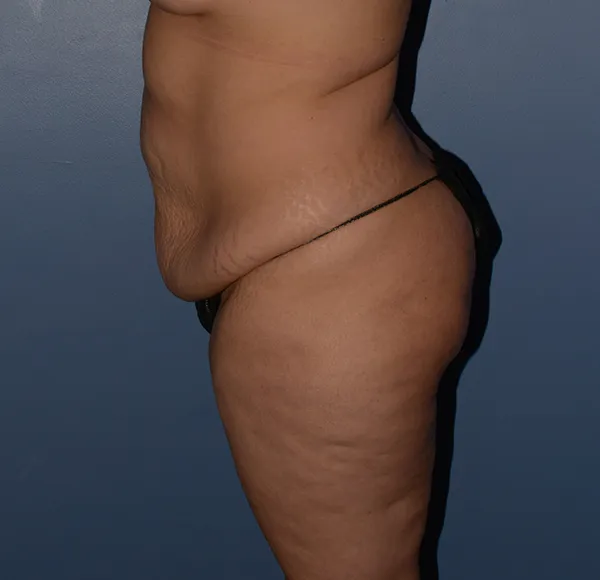 Tummy Tuck