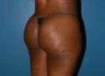 Brazilian Butt Lift