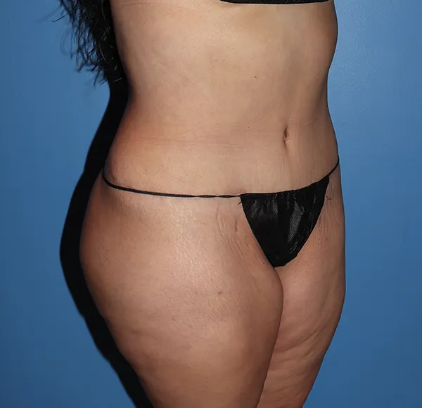 Tummy Tuck