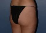 Brazilian Butt Lift