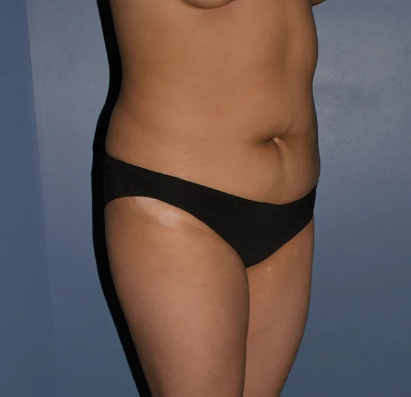 Tummy Tuck