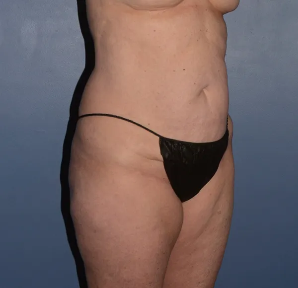Tummy Tuck