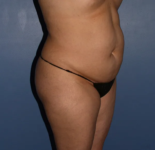 Tummy Tuck