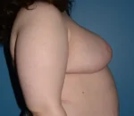 Breast Reduction