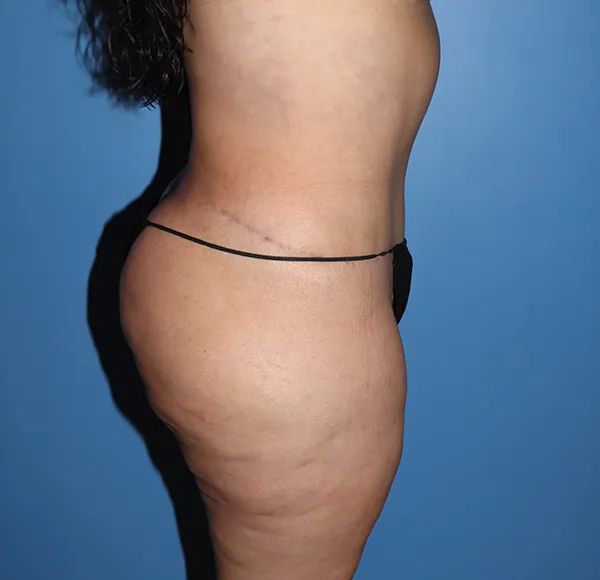 Tummy Tuck