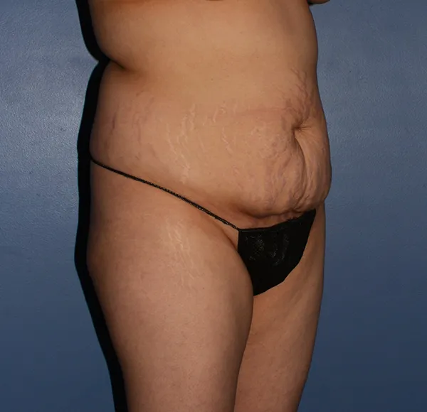 Tummy Tuck
