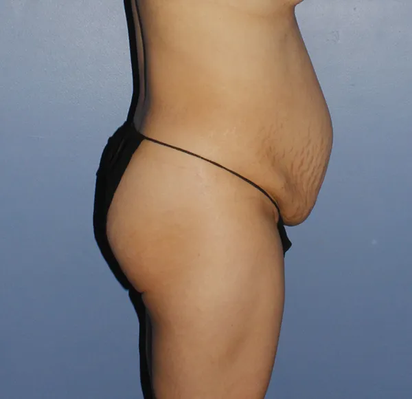 Tummy Tuck