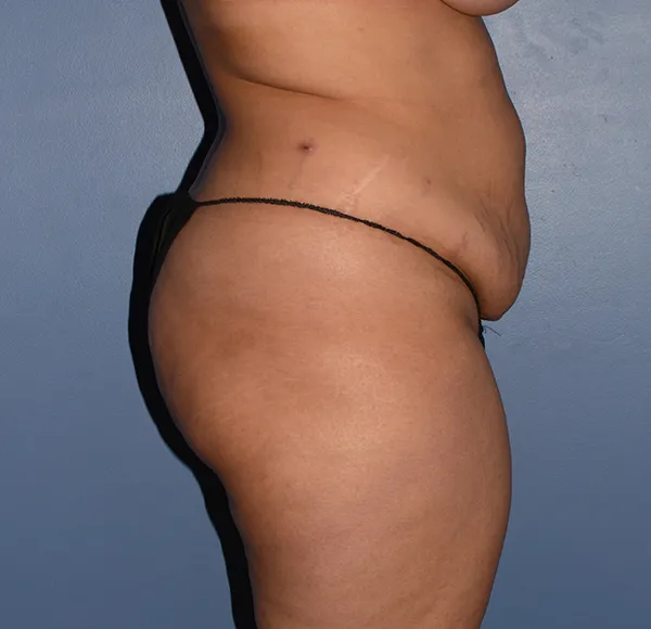 Tummy Tuck