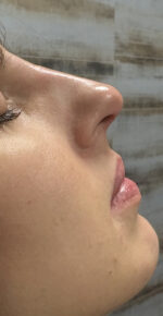 Non-Surgical Rhinoplasty