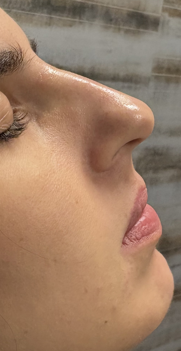 Non-Surgical Rhinoplasty